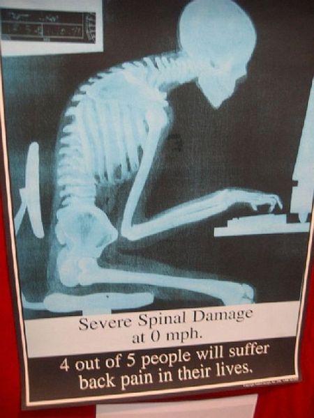 Severe spinal damage at 0mph