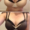 Breast enhancement Breast enhancement