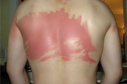 Sunscreen fail